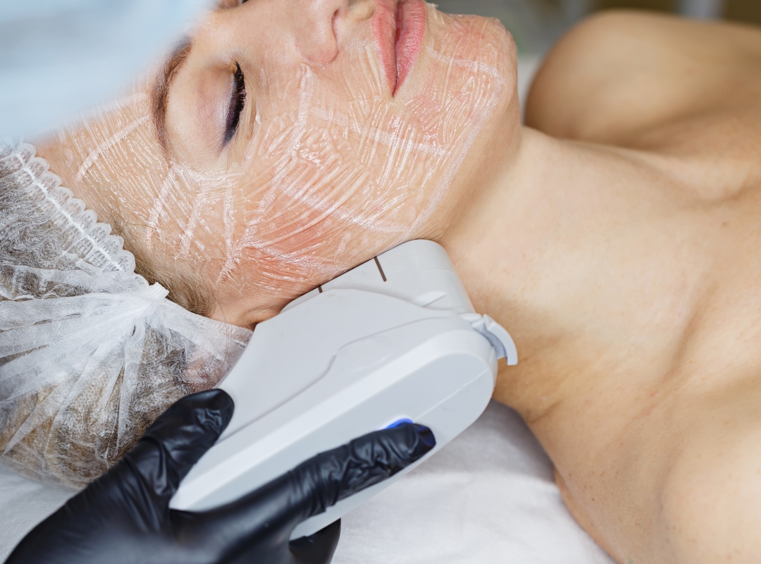 Imagem do post: Pele Sensível Pode Fazer Laser? O Que Você Precisa Saber Antes