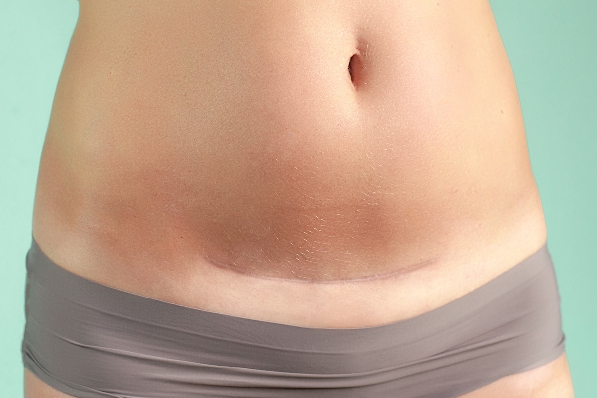 Foto de Cicatrizes Cirúrgicas