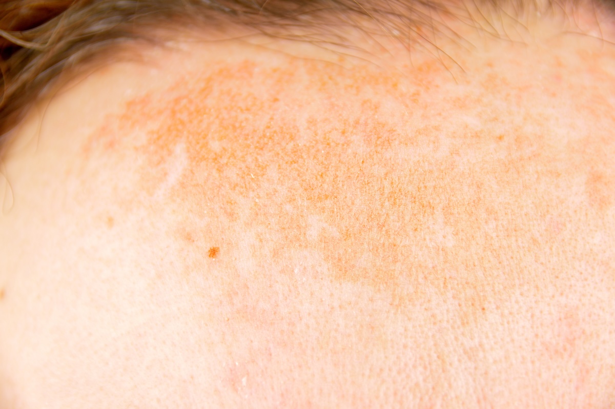 Foto de Melasma