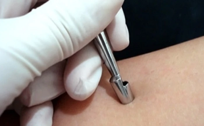 Imagem do serviço Biópsia de Pele