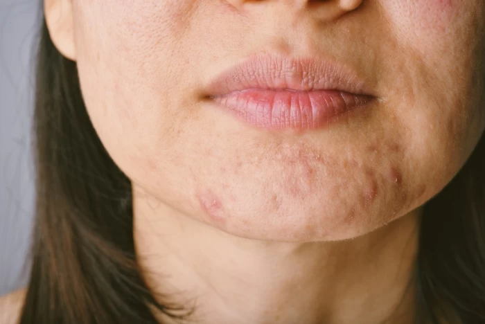 Imagem do serviço Cicatrizes de Acne