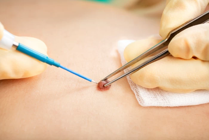 Imagem do serviço Eletrocauterização