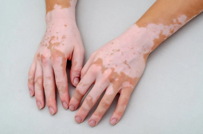 Imagem do serviço Vitiligo